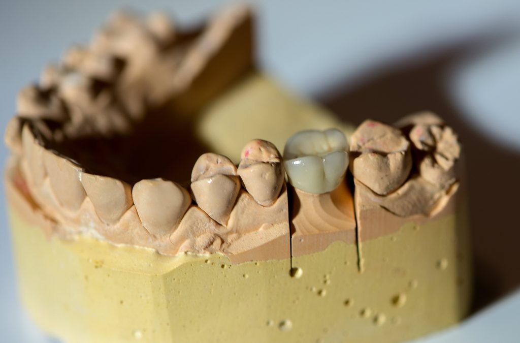 What Are Dental Bridges And How Do They Work? - CureBooking