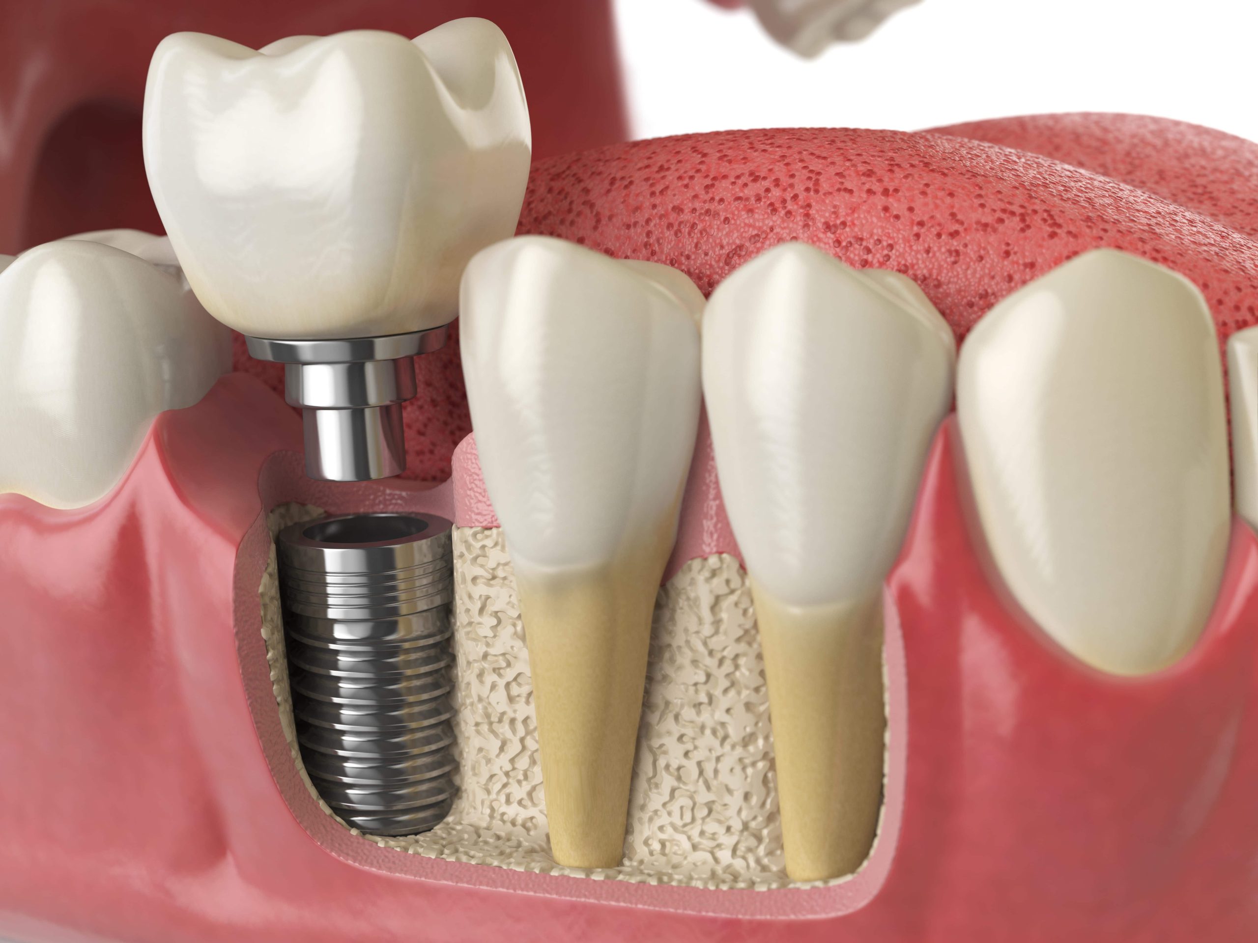 Finland Dental Implant