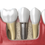 What Should I Pay Attention to in Implant Treatment? Guide to Dental Implants